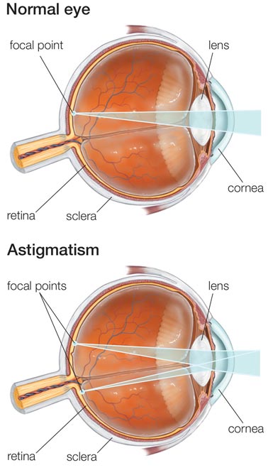 Astigmatism Correction NYC Eye Doctors