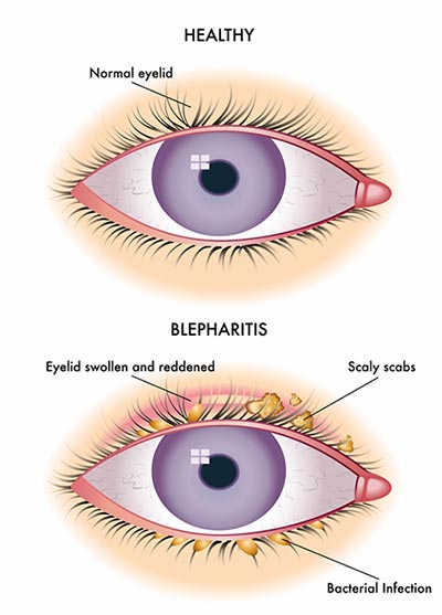 Blepharitis (itchy, dry eyelids) Treatment | NYC Eye Doctors