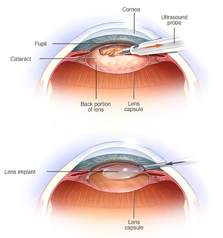 Cataract Removal Surgery · NYC Eye Doctor