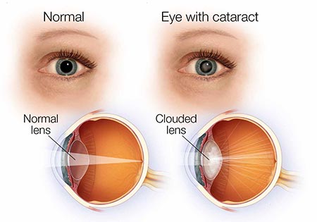 Cataracts · NYC Eye Doctor