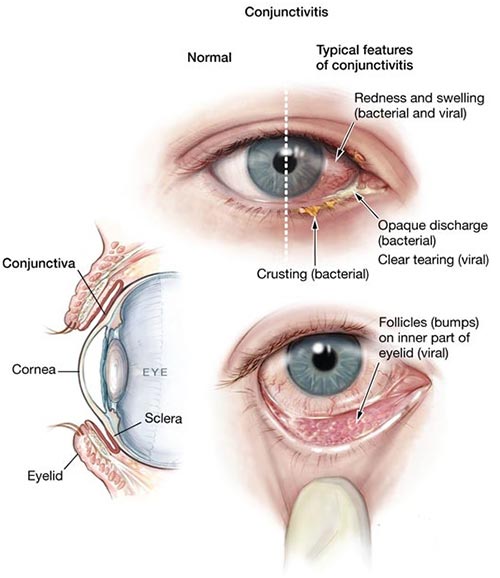 pink eye, conjunctivitis treatment NYC