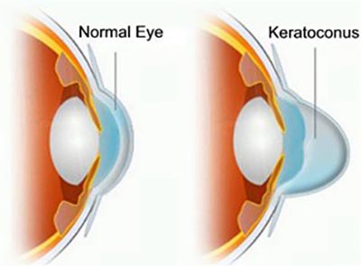 Corneal Cross Linking Cxl Procedure Top Eye Doctor Midtown Nyc