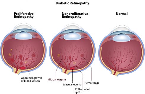 Diabetic Eye Exam NYC Eye Doctor