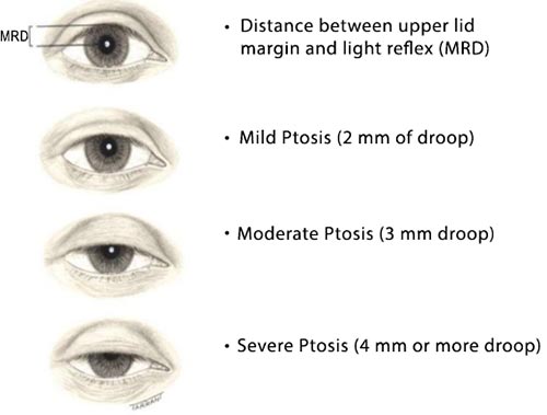 Droopy Eyelid (Ptosis) Treatment NYC