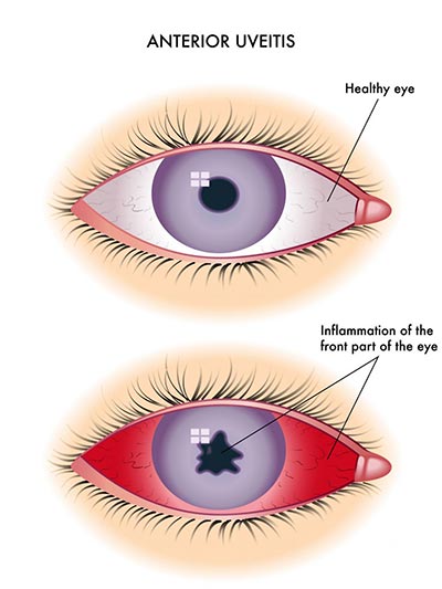 Eye Inflammation (Uveitis) Treatment · NYC