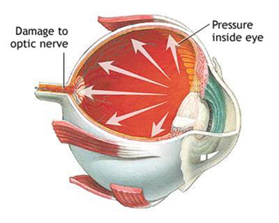 Eye Pressure (Ocular Hypertension)
