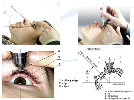 Eye Pressure Test (Tonometry) - NYC