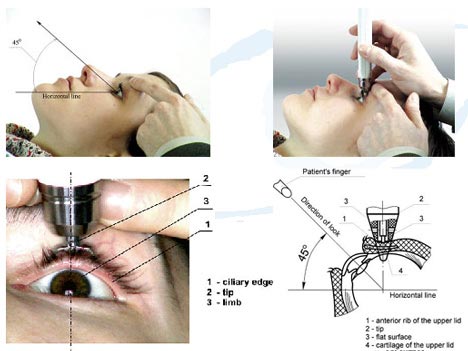 The Importance of IOP & Tonometry Testing