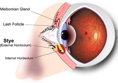 Eye Stye Treatment · NYC Eye Doctor