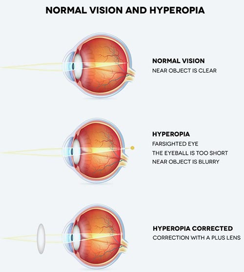 farsightedness, hyperopia