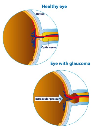 Glaucoma Test NYC