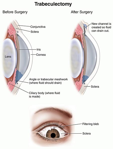 Glaucoma Treatment, Trabeculectomy Surgery NYC