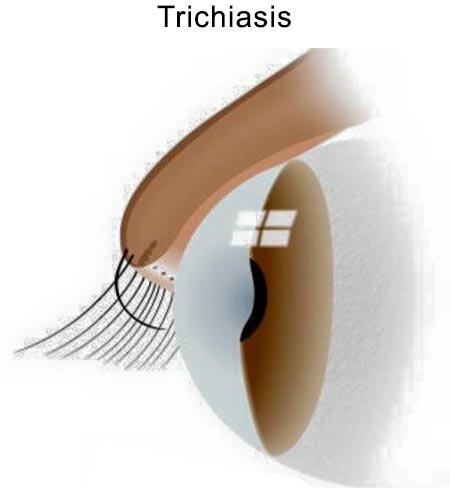 Ingrown Eyelash, Trichiasis Treatment NYC