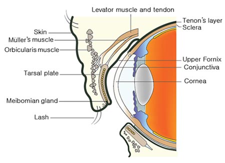 Inverted Eyelashes (Epiblepharon) Repair NYC