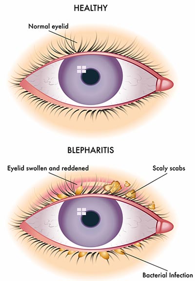 Itchy Eyelids (Blepharitis) treatment NYC