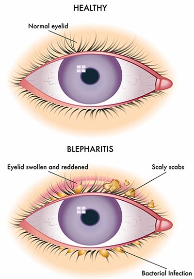 Swollen Eyes And Eyelids: Why And How To Treat Them