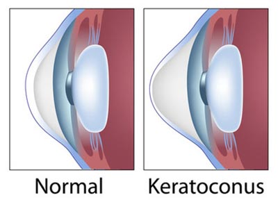 Keratoconus Treatment NYC