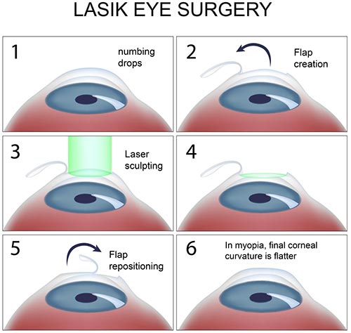 LASIK Eye Surgery procedure NYC