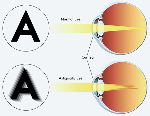 Myopia strabismus amblyopia