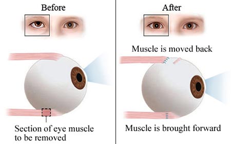 Lazy Eye Surgery NYC