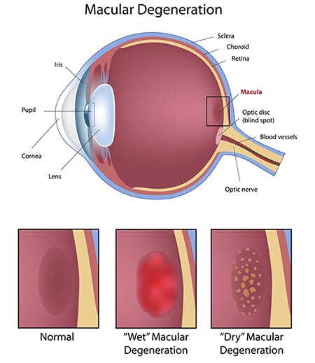 Age Related Macular Degeneration (amd) | NYC Eye Doctors