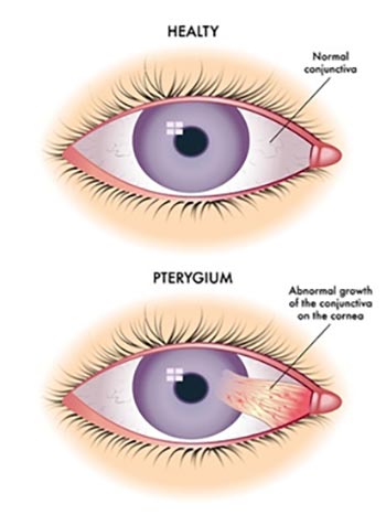 Pterygium Surgery NYC