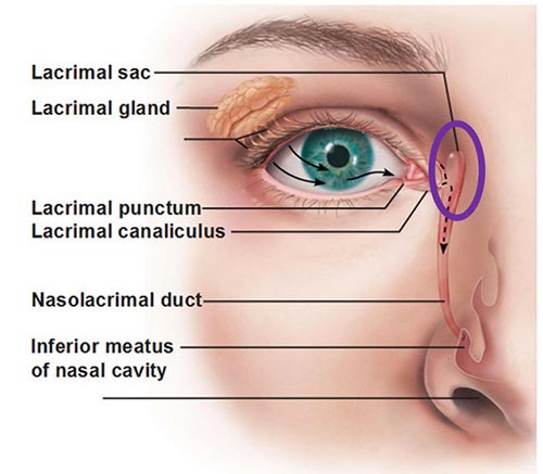 Punctal Occlusion (Punctal Cautery)