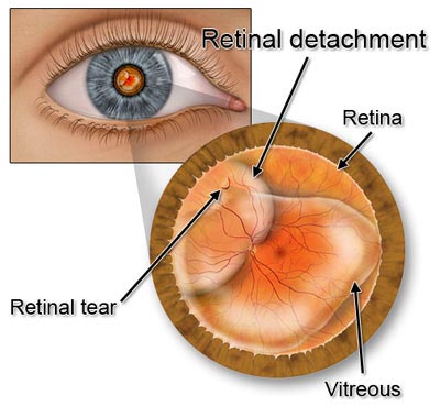 What is Retina in the Eye?