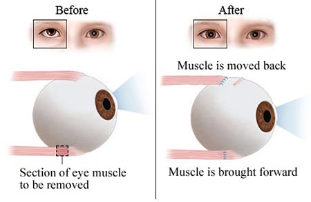 Strabismus | Crossed Eyes
