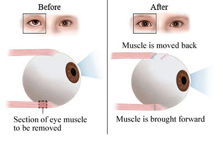 Strabismus Surgery NYC