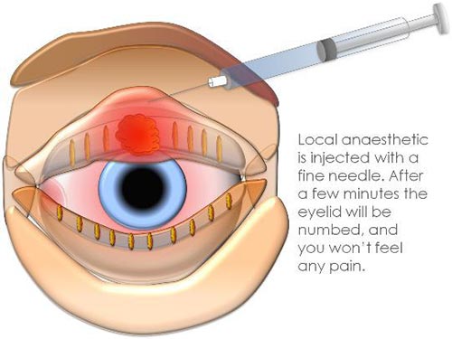 Stye Treatment, Surgery NYC