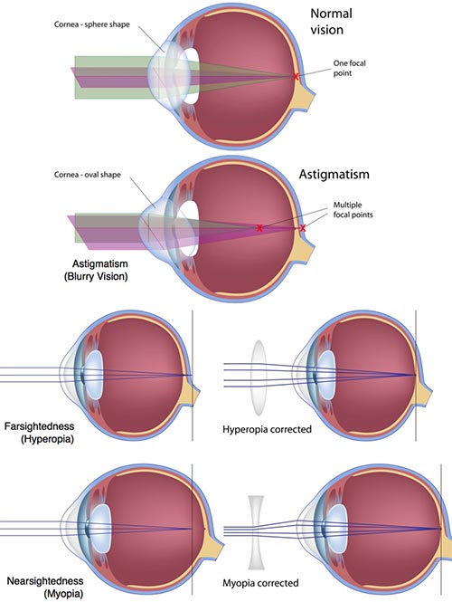 Contact Lenses Orlando