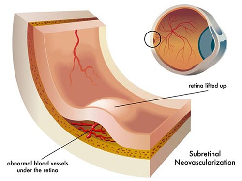 Vitreous Detachment, Degeneration NYC