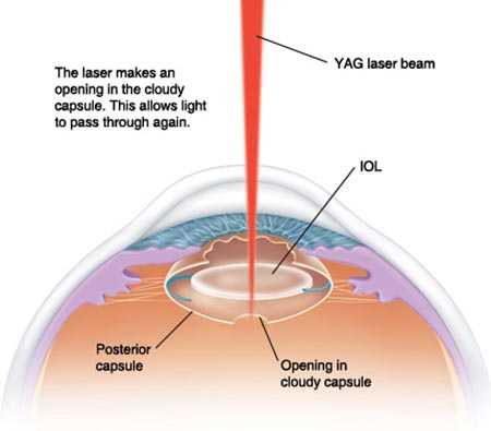 YAG Capsulotomy Complications