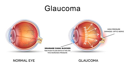Glaucoma · NYC Eye Doctor