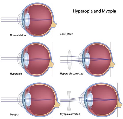 Refractive Error Treatment NYC