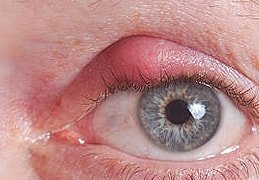 Blepharitis