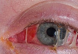 Conjunctivitis