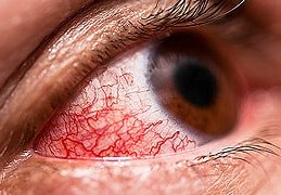 Uveitis (eye inflammation)